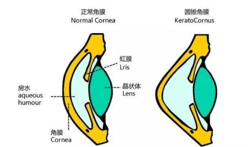 圆锥角膜患者经济困难 获公益帮助在我院角膜交联手术